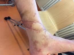 Die untersuchung zeigt schmerzen um den malleolus herum und an bestimmten stellen der tibia oder fibula (beinknochen). Der Einsatz Des Neuro Fasziokutanen Suralisinsellappens Zur Defektdeckung Im Bereich Des Unterschenkels Und Des Fusses Sciencedirect