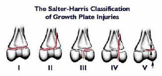 The Growth Plate - Connecticut Orthopaedics