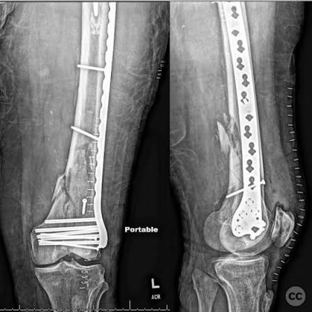 Distal Femur Fracture Treatment, Locking Plate MIPO & Retrograde Nailing in Jamshedpur | Dr. Pritpal Singh Saini