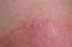 Mai mult decat atat, uterul meu este inflamar aproape tot timpului, imi da dureri. Micoza Inghinala Danihilldesign Com