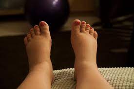When To See A Doctor For Swollen Feet Treatment