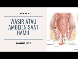 We did not find results for: Wasir Berdarah Bahayakah Wasir Berdarah