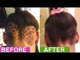 How to disguise your thinning hair it may take months for you to regrow your hair (and truthfully, it may not grow back at all). Emu Oil For Traction Alopecia Bald Spot And Thin Edges How To Grow Back Your Edges Youtube Hairlo Thick Hair Remedies Regrow Hair Naturally Help Hair Loss