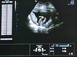 Meine erste ss ist 9 jahre her und da kann ich mich nicht mehr so dran erinnern wann man das geschlecht sehen konnte. 15 Ssw Und Geschlecht Gesagt Bekommen Schwangerschaftsgruppe Babycenter