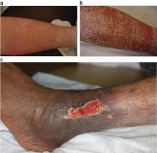 Image result for Stasis Dermatitis