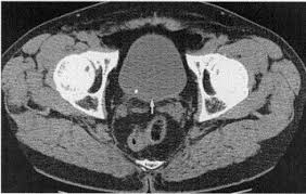 Image result for Helical CT Urogram