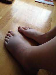 Som regel oppstår denne typen brudd i forbindelse med fall eller overtråkk. Noen Som Har Hatt Et Brudd I Ankelen Men Som Likevel Greide A Ga Pa Foten Noen Radiografer Her Inne Skravle Foreldreforum