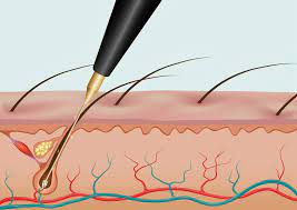 Electrolysis can be used to treat almost every area of your body (even facial hair). Electrolysis Emoveo