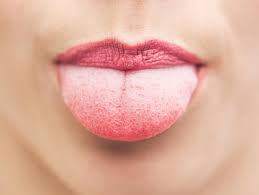 Como Curar Una Quemadura En La Lengua 6 Pasos