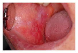 Image result for lichen planus on tongue)
