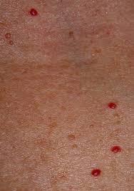 The Little Red Dots You Can See Are An Example Of Cherry Angiomas Campbell De Morgan Spots T Thyroid Health Iodine Thyroid