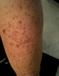 Dark Spots On Feet Are Common These Days Thanks To The Harsh Sun Rays And Unhealthy Habits Of People Around Spots On Legs Remove Dark Spots Dark Spots On Legs