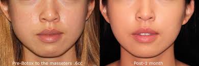 How much botox should you get? 4 Types Of Jawline Reduction And Enhancement