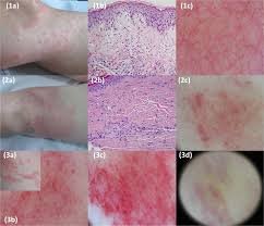 Image result for Diascopy