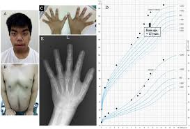 Image result for Precocious Puberty