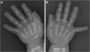 A Simple Method For Bone Age Assessment The Capitohamate