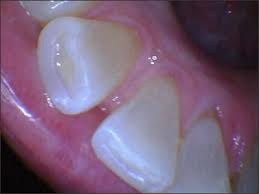 Clinical Signs Of Bruxism Bruxism The Grind Of The Matter Continuing Education Course Dentalcare Com