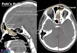 Image result for Sinus CT