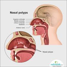 Maybe you would like to learn more about one of these? Nasal Polyps Causes Symptoms And Treatment Netmeds