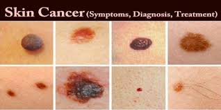 Merkel cells are the cells in the epidermis, the top layer of skin. Skin Cancer Symptoms Diagnosis Treatment Assignment Point