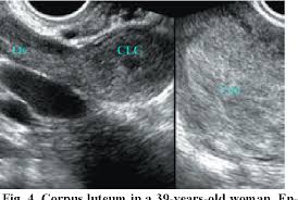 Image result for corpus luteum sonography)