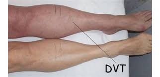 Sitting for long periods can cause clots to form in the veins of your legs. å¤´æ¡æ–‡ç« 