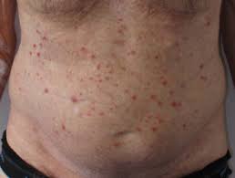 Aitl is generally a rapidly progressive disease. Angioimmunoblastic T Cell Lymphoma Dermnet Nz