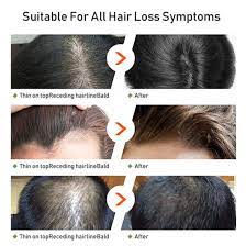 While biotin has proven benefits for hair growth in people with biotin deficiencies, it doesn't have any effect on male pattern baldness.mpb is hormonal and genetic, and biotin, as a vitamin, simply isn't involved in the male balding process. Custom Best Hair Loss Treatment Biotin Hair Growth Serum Kit China Hair Growth Serum And Hair Serum Growth Price Made In China Com