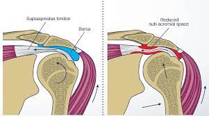 Download scientific diagram | shoulder impingement position. Shoulder Impingement Stephane Andre