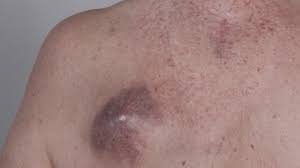 Some early cancers may have signs and symptoms that can be noticed, but that is not always the case. Symptoms And Pictures Of Stage 4 Melanoma