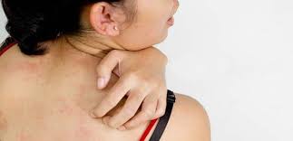 Cara Mengatasi Gatal Kaligata Biduran Dengan Terapi Sederhana Psoriasis Jerawat Terapi