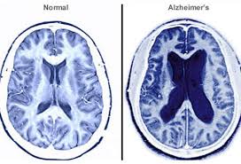 Both scans are invaluable tools for diagnosing and monitoring disease. Caring For Someone With Alzheimer S Disease