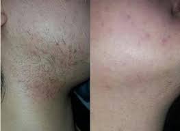 Now men and women alike are making unwanted hair on the bikini line, face, legs, arms, back and other areas a thing of the past with laser hair removal. Laser Hair Removal Full Body Laser Hair Removal