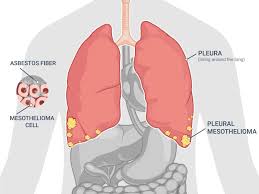 The pancreas is an organ that releases enzymes involved with digestion, and hormones to regular blood sugar levels. Mesothelioma Symptoms And Treatment