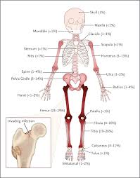 Image result for Osteomyelitis