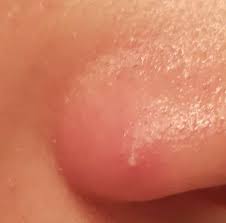 Die gefahr bei gesichtsfurunkeln ist ja, daß bakterien über die blutegefäße weiterin der region verteilt werden. Nasenfurunkel Oder Pickel Gesundheit Und Medizin Arzt Nase