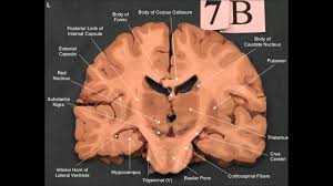 Each brain hemisphere (parts of the cerebrum) has four sections, called lobes: Neuroanatomy Coronal Brain Slices Youtube