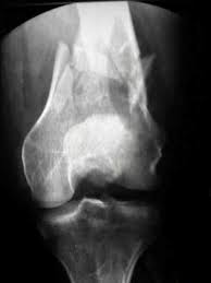 Fracture fixation, internal / methods*. Supracondylar Femoral Fractures Wheeless Textbook Of Orthopaedics