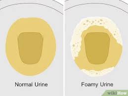 View all of faomy's galleries here. 6 Ways To Reduce Foamy Urine Wikihow