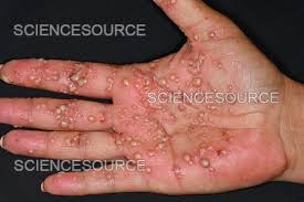 Image result for Pustular Psoriasis