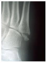 A jones fracture is often caused by a forceful blow to the bottom or outside part of your foot. Fifth Metatarsal Fractures And Current Treatment