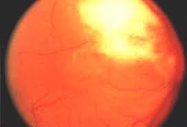 Image result for HIV Retinitis