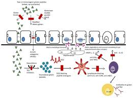 Diagnosis and management of celiac disease. Novel Therapeutic Approaches For Celiac Disease Rohini R Vanga Discovery Medicine