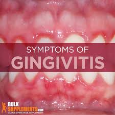 Image result for Gingivitis