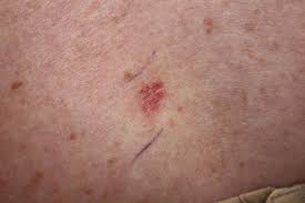 Is it true a mole on bottom of foot is sign of skin cancer answered by dr. Skin Cancer And Other Lesions Clark Nj Foot Doctor