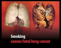 In addition to disorders of the stool, the patient has pneumonia is an inflammatory condition of the lung affecting primarily the microscopic air sacs known as alveoli. Pin On Human Anatomy
