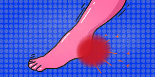 Почему болят пятки и что с этим делать — Лайфхакер