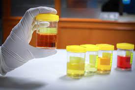 Kemungkinan besar, warna putih jadi tanda adanya endapan dari mineral hiperkalsiuria, fosfaturia, atau hiperoksaluria yang bisa menyebabkan infeksi saluran kemih yang berat. Macam Macam Warna Urine Dan Maknanya Honestdocs