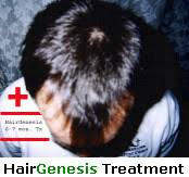 Get the best deals on serum hair growth promoters. Authorized Hairgenesis Web Site Does Hairgenesis Work Order Hair Genesis Dht Blockers Buy Hairgenesis Brand Compare Reviews
