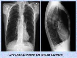 Presentation1 Pptx Radiological Imaging Of Copd